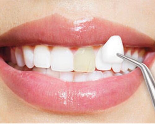 Fațete dentare. Soluția pentru un zâmbet impecabil și plin de încredere