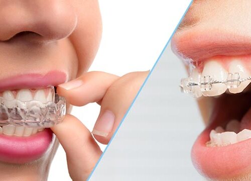 Aparat dentar – dinți sănătoși și perfect aliniați