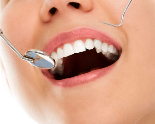Clinica stomatologică – Albire dentară profesională