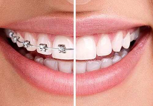 Cele mai frecvente mituri despre aparatul dentar