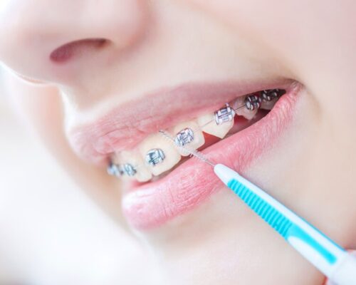 Cum îngrjim dinții atunci când purtăm aparat dentar?