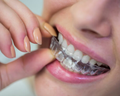 Noutăți în ortodonție
