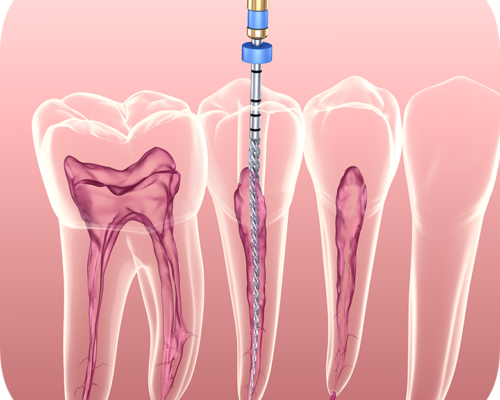 Tratamentul endodontic
