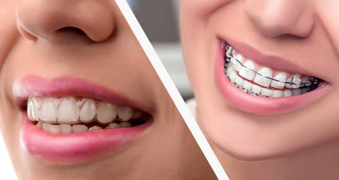 Aparate dentare clasice sau aparate dentare moderne Spark